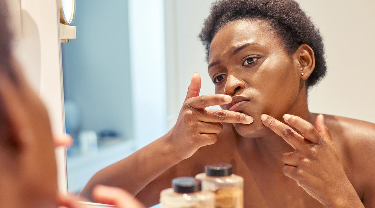 Don’t worry, that pregnancy acne is normal. Here’s how to manage it