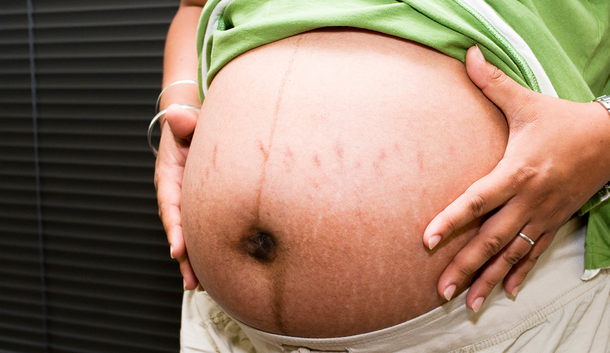 Don’t want to put up with stretch marks in pregnancy? You don’t have to